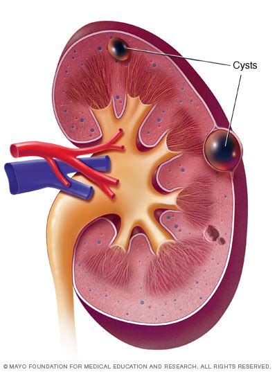 renal cyst diagram 